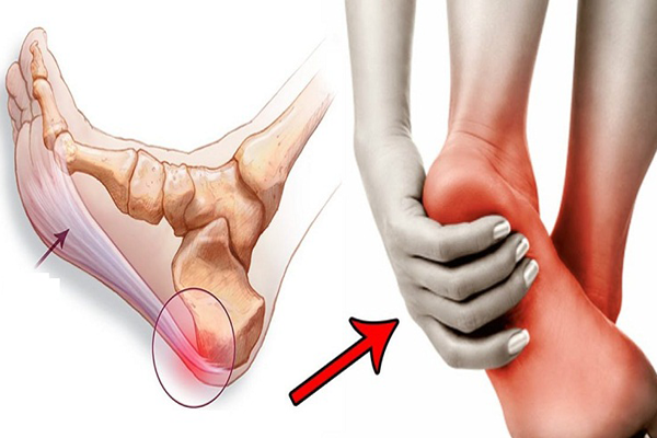 درد کف پا یا پلنتار فاسیتیس چیست و چگونه درمان می شود؟