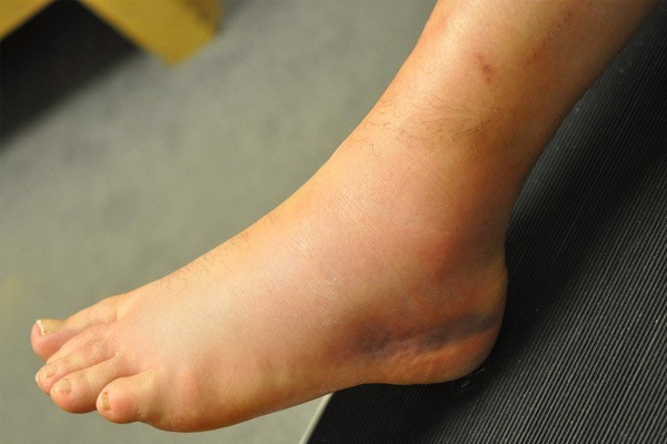  Những sai lầm thường gặp khi xử lý chấn thương trật khớp bàn chân