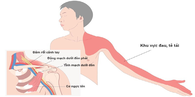 /uploads/1750560496-hoi-chung-thoat-long-nguc-voi-phan-nguc-long-leo-khong-binh-thuong.jpg