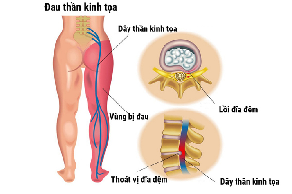 10 thói quen gây đau thần kinh tọa mà bạn cần tránh ngay