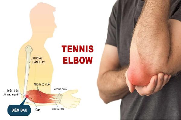 Hội chứng Tennis Elbow: Nguyên nhân, triệu chứng và cách điều trị hiệu quả