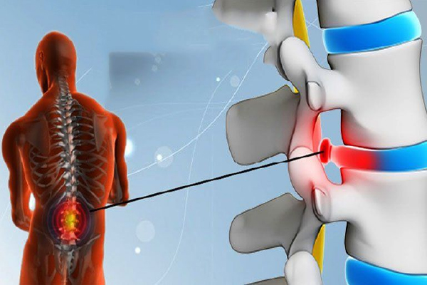 Nhận biết triệu chứng và cách điều trị lồi đĩa đệm