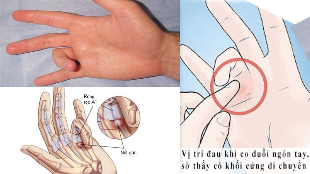 /uploads/1786709017-nguyen-nhan-va-bieu-hien-benh-ngon-tay-co-sung.jpg